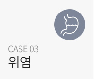 위염